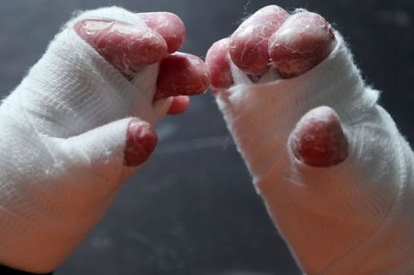 Bệnh ly thượng bì bọng nước bẩm sinh là do sự đột biến gen di truyền.