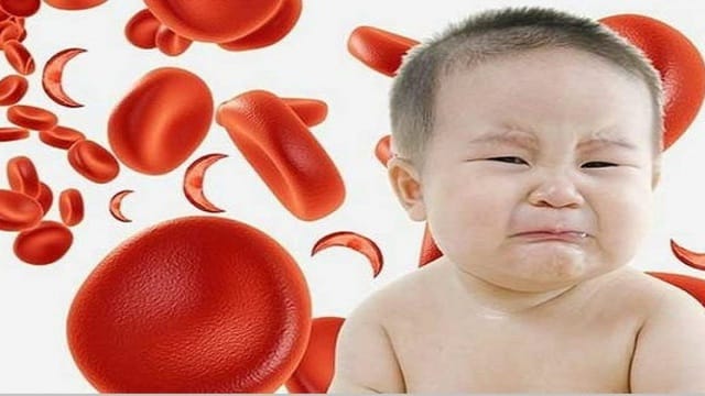 Trẻ thiếu máu có số lượng tế bào hồng cầu ít, dẫn đến da nhạt màu hơn bình thường.
