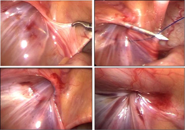 Phẫu thuật là phương pháp điều trị duy nhất để điều trị bệnh lý thoát vị bẹn.