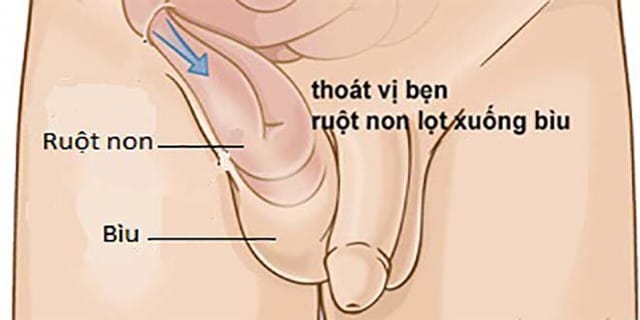 Thoát vị bẹn, một bệnh lý cần được phát hiện và xử trí càng sớm càng tốt cho trẻ .