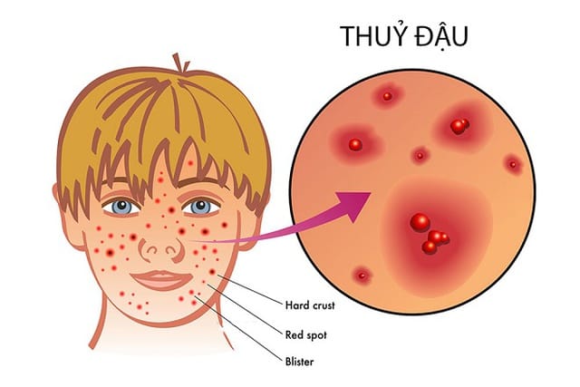 Thủy đậu một bệnh truyền nhiễm cấp tính do virus Herpes Zoster gây nên.