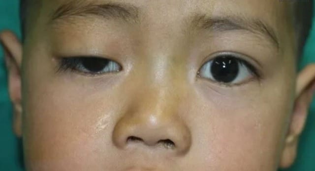 Trẻ bị nhược cơ có thể biểu hiện sụp mí, yếu cơ mặt hoặc khó thở – dễ nhầm với các bệnh khác nếu không được thăm khám kỹ.