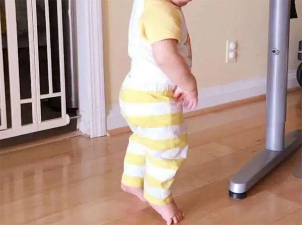 Tật đứng đi nhón gót nguyên nhân là do bất thường về phát triển tinh thần vận động.