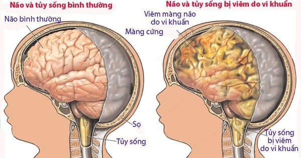 Viêm não cấp là một tình trạng viêm cấp tính của nhu mô não.