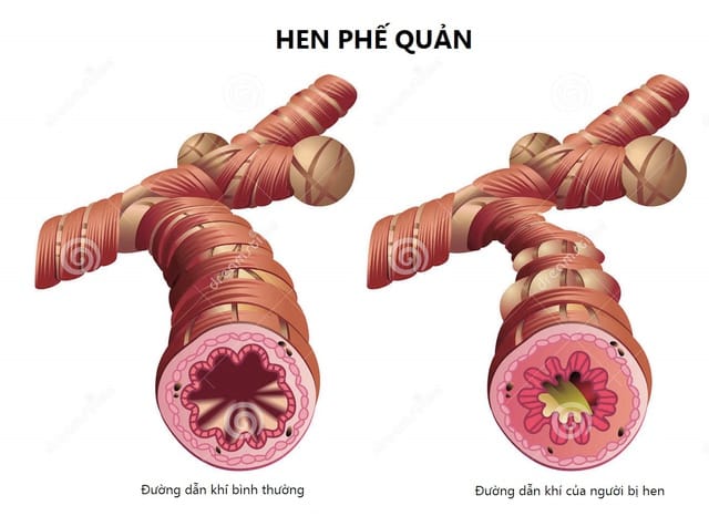 Hen suyễn là bệnh hô hấp mạn tính thường gặp ở trẻ em.