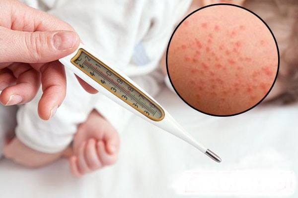 Sởi là bệnh do virus gây ra và dễ lây lan nên biện pháp phòng chống là rất quan trọng. Ảnh minh họa.