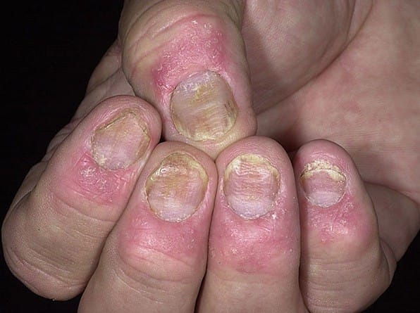 Biểu hiện ban đầu khi bị nấm móng tay là những đốm trắng hoặc vàng xuất hiện dưới các đầu móng tay.