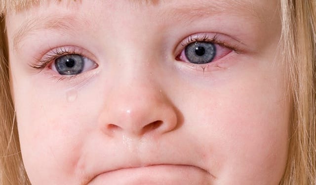 Viêm kết mạc ở trẻ hay còn gọi là đau mắt đỏ là bệnh phổ biến.