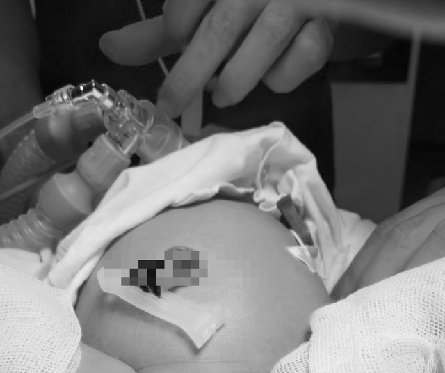 Gia đình cần đặc biệt lưu ý đến trẻ sau sinh, nhất là vấn đề đại, tiểu tiện của trẻ.