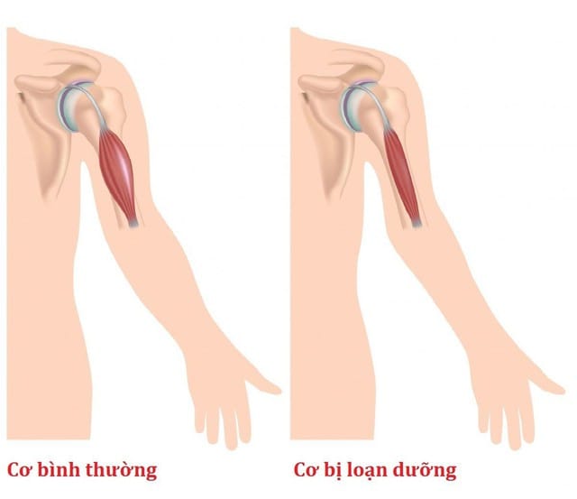 Loạn dưỡng cơ tiến triển xảy ra do các bất thường về di truyền.
