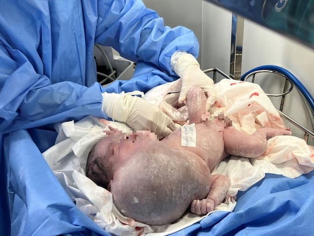 Bé trai có khối bướu dị dạng bạch huyết lớn nhất trong y văn thế giới (Ảnh: BVCC)