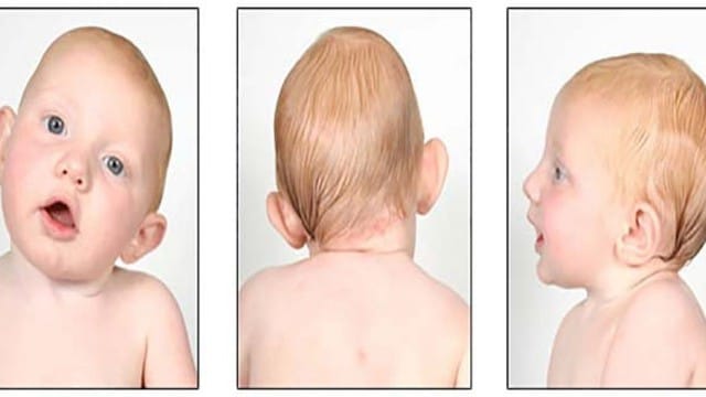 Vẹo cổ là một bệnh lý thường gặp ở trẻ nhỏ từ 0 tới 6 tháng tuổi. Ảnh minh hoạ.