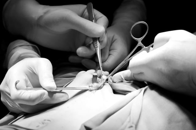 Tinh hoàn phải ẩn được phẫu thuật viên đưa xuống bìu.