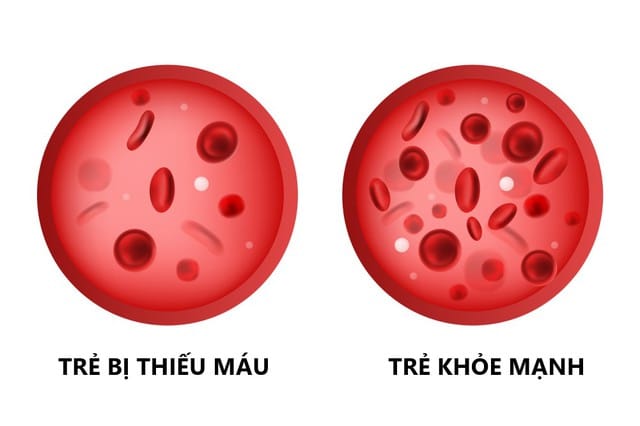 Thiếu máu, thiếu sắt ở trẻ em do nhiều nguyên nhân, trong đó chủ yếu do cung cấp sắt thiếu.