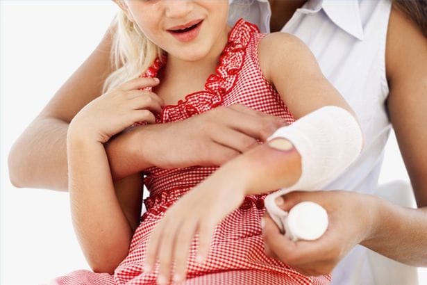 Bỏng là tai nạn dễ gặp ở trẻ nếu không được cấp cứu và điều trị kịp thời dễ gây biến chứng. Ảnh minh hoạ.