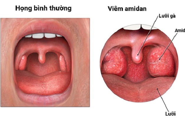 Viêm amidan là tình trạng viêm cấp gây sung huyết thường gặp ở trẻ trên 5 tuổi.