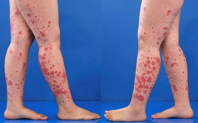 Khi mắc viêm mao mạch dị ứng, da trẻ xuất hiện phát ban, chủ yếu ở 2 cẳng chân và tay.