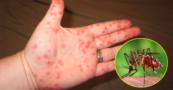 Bệnh nhiễm virus rất hay gặp và cần lưu ý vào mùa mưa là bệnh sốt xuất huyết.