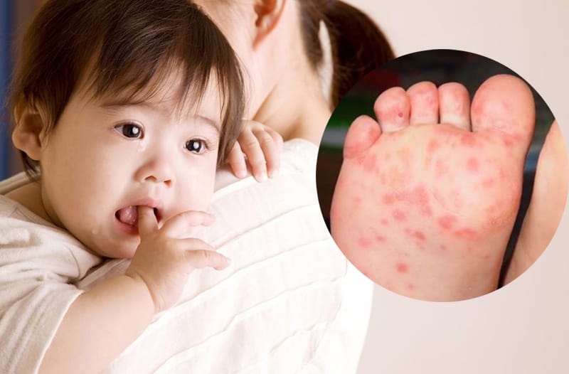 Bệnh tay chân miệng do virus gây ra nên không có thuốc điều trị đặc hiệu. Ảnh minh hoạ.