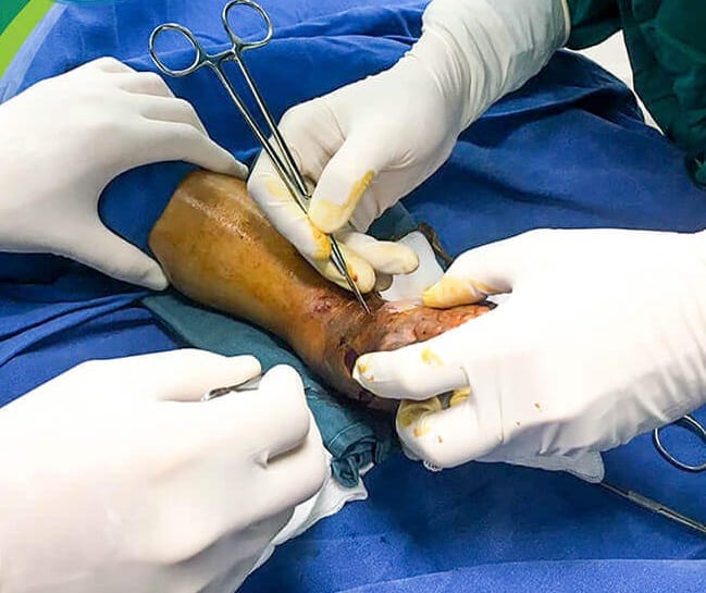 Các bác sĩ Khoa Chỉnh BV Nhi Trung ương hình tiến hành phẫu thuật mở cân để giải phóng chèn ép khoang tại vị trí chân trái của trẻ bị rắn độc cắn.