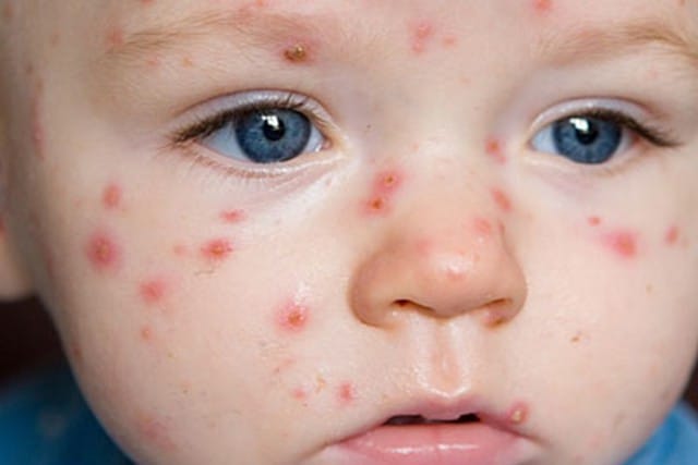 Thủy đậu hay còn gọi là phỏng dạ, trái dạ bệnh do virus Varicella Zoster gây nên. Ảnh minh hoạ.
