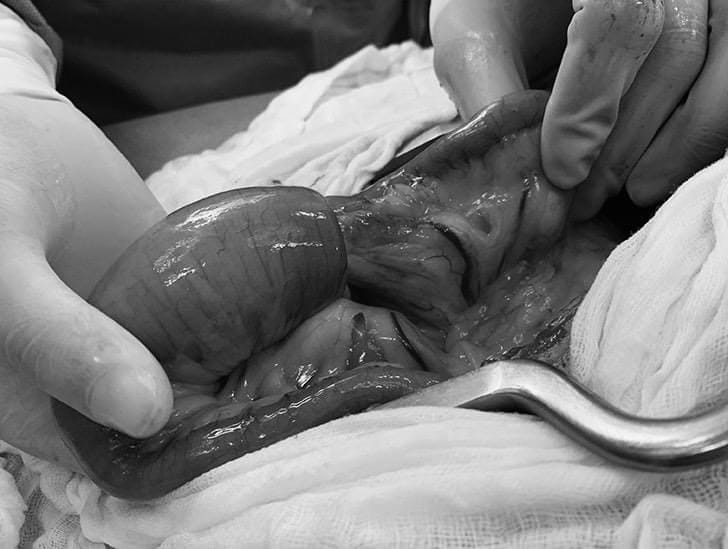 Hình ảnh phẫu thuật lồng ruột cho trẻ tại Bệnh viện Hữu nghị Việt Đức.