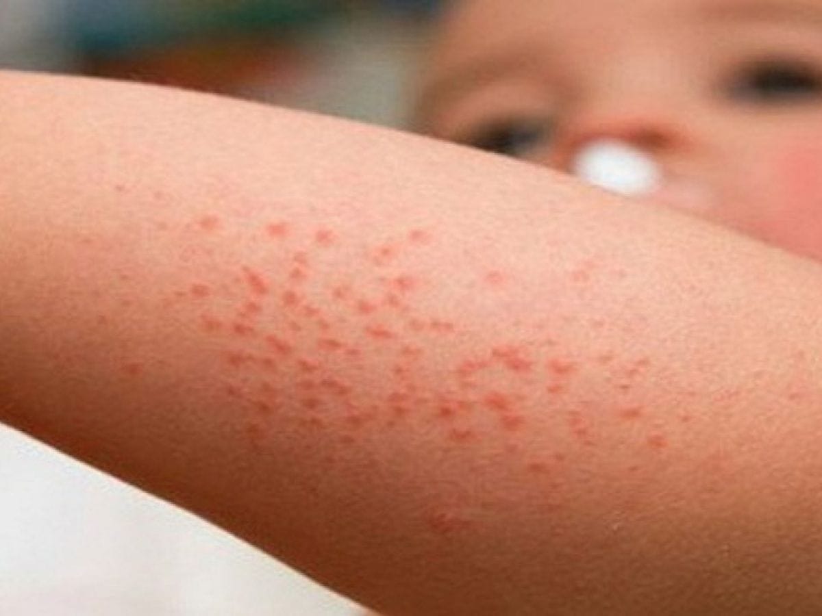 Khi trẻ mắc sẩn ngứa cần hạn chế cho trẻ cào gãi, chà xát.