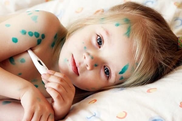 Thủy đậu nếu chăm sóc không đúng các mụn nước sẽ có thể viêm da bội nhiễm, để lại sẹo lõm trên da. Ảnh minh hoạ.