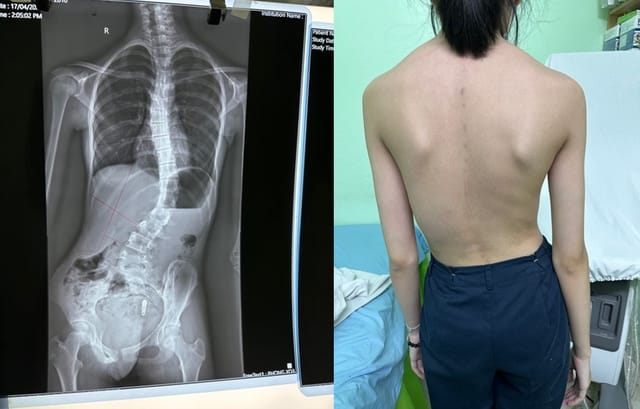 Hình ảnh trẻ bị cong vẹo cột sống.