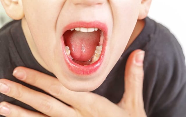 Viêm amidan quá phát là tình trạng amidan bị viêm nhiễm nhiều lần và kéo dài lâu ngày.