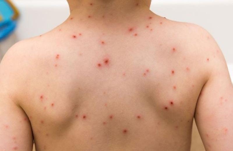 Bệnh sởi là một trong những bệnh hay gặp ở trẻ em vào mùa xuân.