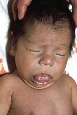 Suy giáp ở trẻ sơ sinh thường ít có triệu chứng và cha mẹ dễ bỏ qua .