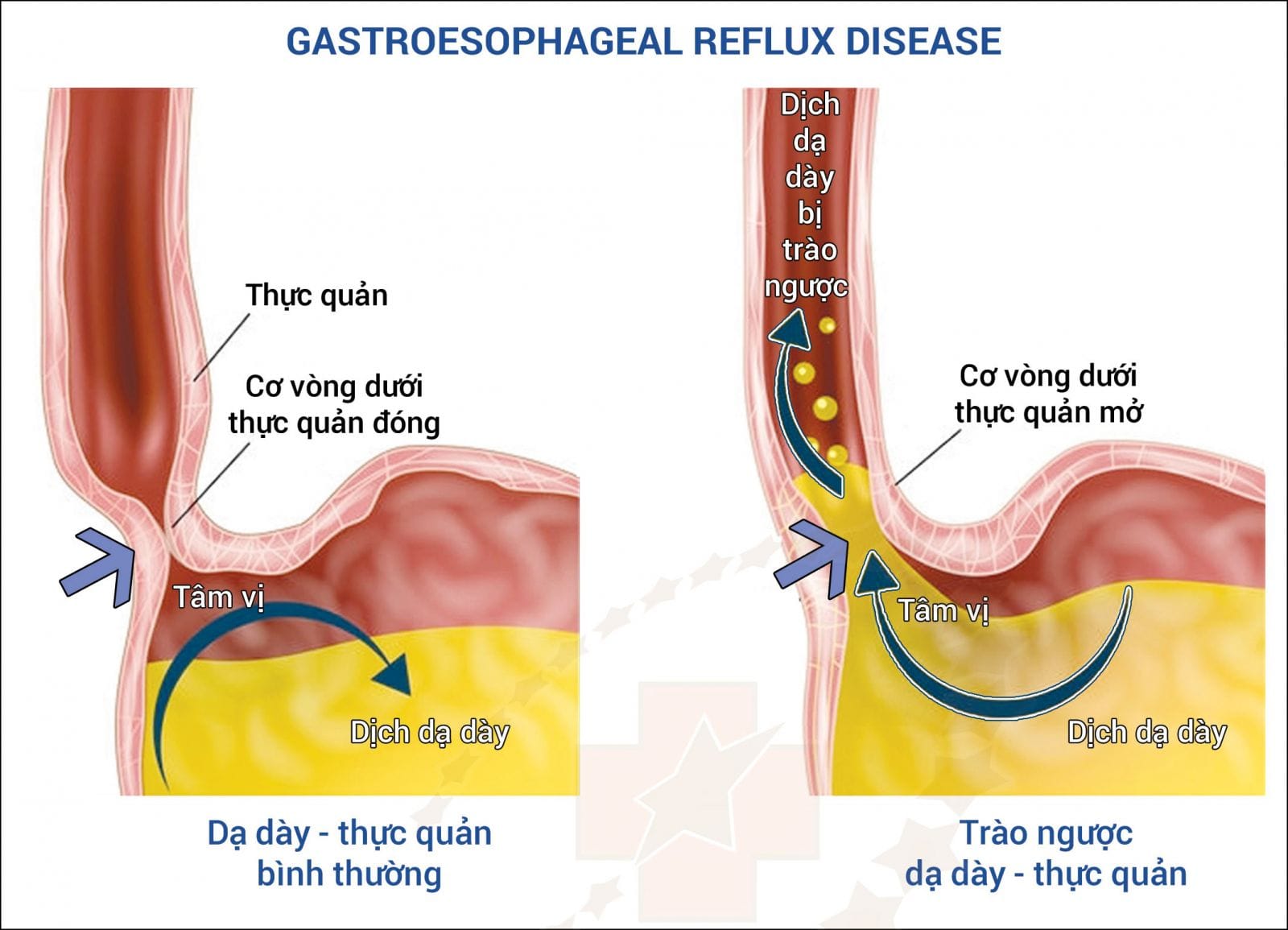 Cấu tạo thực quản dạ dày khiến trẻ nhỏ dễ bị trào ngược dạ dày thực quản.