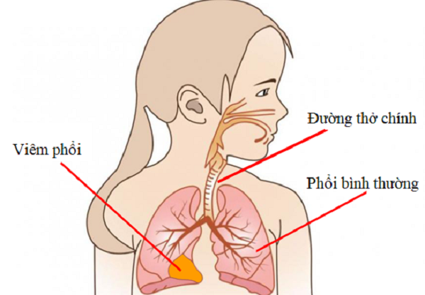 Hình ảnh tổn thương phổi bị viêm.