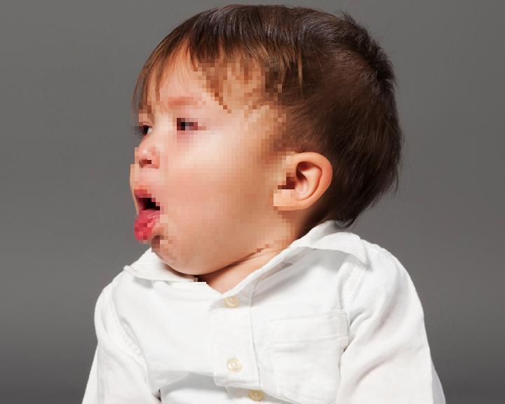 Khi mắc ho gà, trẻ ho rũ rượi từng cơn liên tục, kéo dài, sau cơn ho có lúc ngừng thở, tím tái. Ảnh minh họa