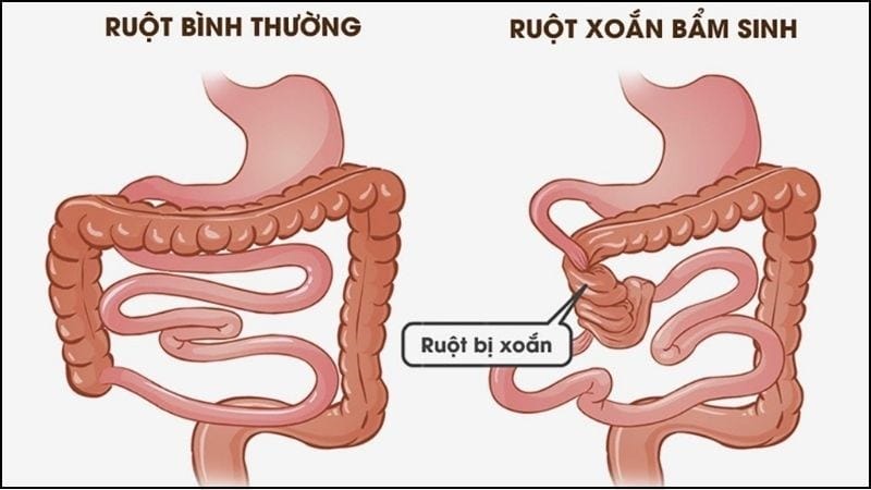 Xoắn ruột là một dạng của tắc ruột, đây là hội chứng cấp cứu ngoại khoa thường gặp ở cả người lớn và trẻ em.