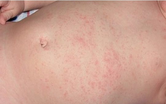 Bệnh nhân mắc rôm sảy.