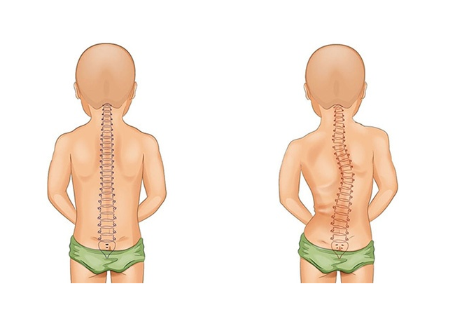 Cong vẹo cột sống là căn bệnh khá phổ biến ở trẻ em.