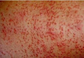 Người bệnh bị rôm sẩy có biến chứng viêm nang lông