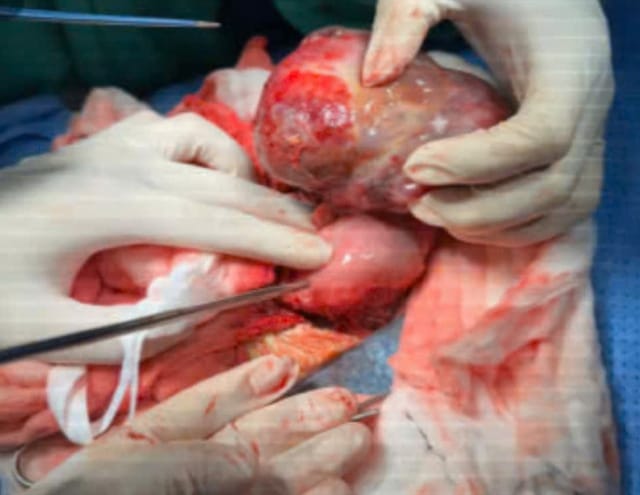 Đây là ca bệnh u quái dạ dày sơ sinh đầu tiên tại Việt Nam. Ảnh: BVCC.