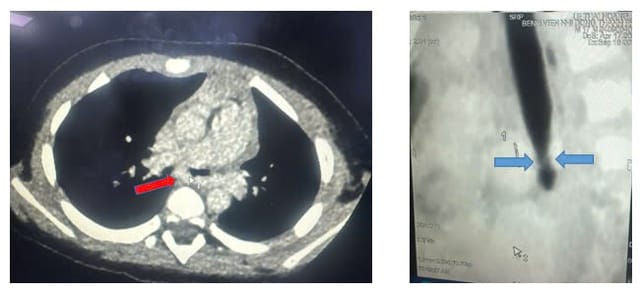 Kết quả CT - scan ngực cho thấy động mạch phổi trái quấn hẹp khí quản gốc, mặt cắt dọc đứng thấy hẹp khí quản gốc (carina). Ảnh: BVCC.