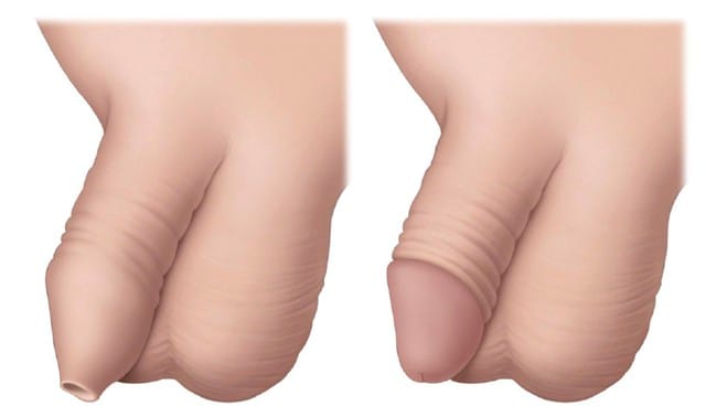 Hẹp bao quy đầu ở trẻ là một bệnh lý khá phổ biến và không quá nguy hiểm.