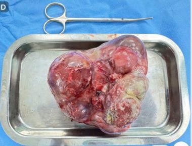 Khối u quái nặng 1kg được lấy ra khỏi cơ thể bệnh nhi 1 tháng tuổi. Ảnh: BVCC.