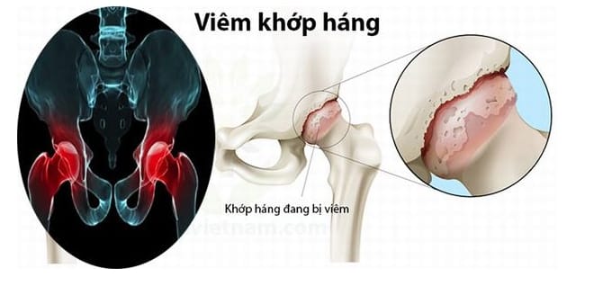 Hình ảnh viêm khớp háng