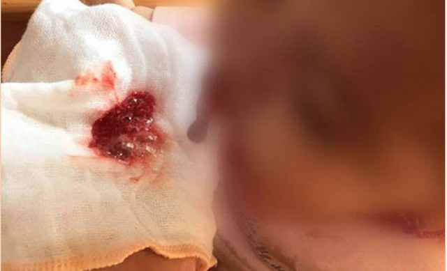 Bệnh nhi viêm tụy cấp có thể ho, nôn ra máu. Ảnh minh họa