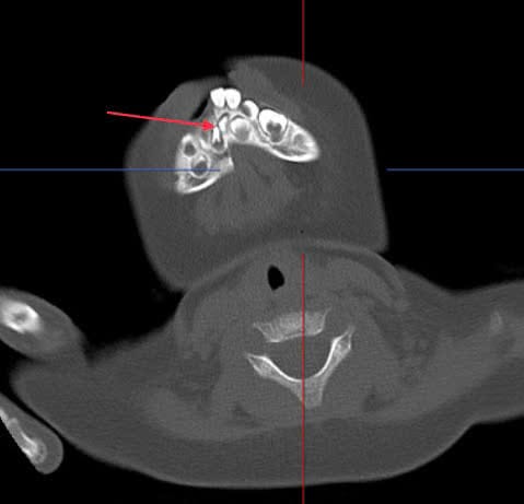 Hình ảnh bệnh nhi bị gãy xương hàm dưới