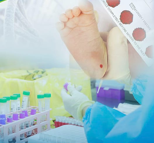 Sàng lọc sơ sinh là biện pháp phòng bệnh tích cực cho nhóm bệnh rối loạn chuyển hoá bẩm sinh axit amin.