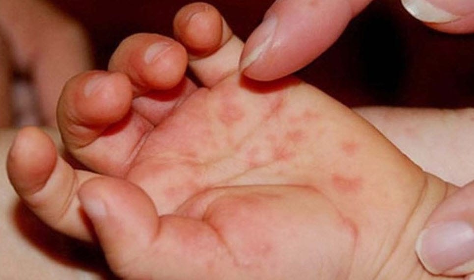 Tay chân miệng là bệnh do virus gây ra, lây truyền chủ yếu qua đường tiêu hóa và tiếp xúc trực tiếp.