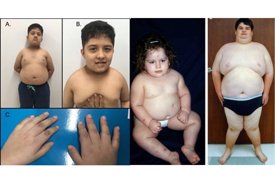 Thủ phạm gây hội chứng Prader-Willi là do nhiễm sắc thể 15.