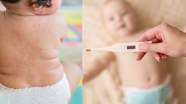 Khoảng 70% trẻ bị sốt phát ban là do virus gây ra.